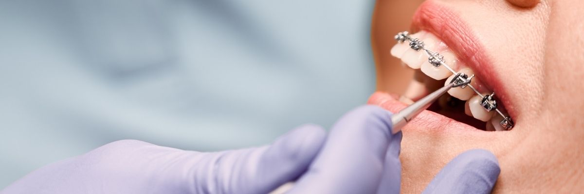 Ortodonti Diş Teli Ortodonti Diş Teli hakkında bilgi